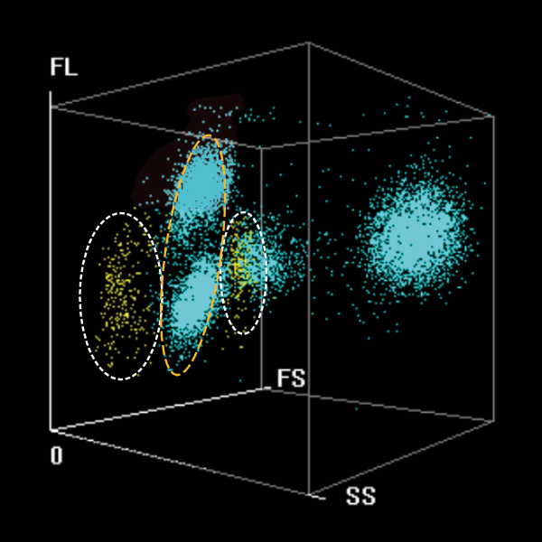 BC-7600 Series Auto Hematology Analyzers - Typical samples ofhairy cell leukemia