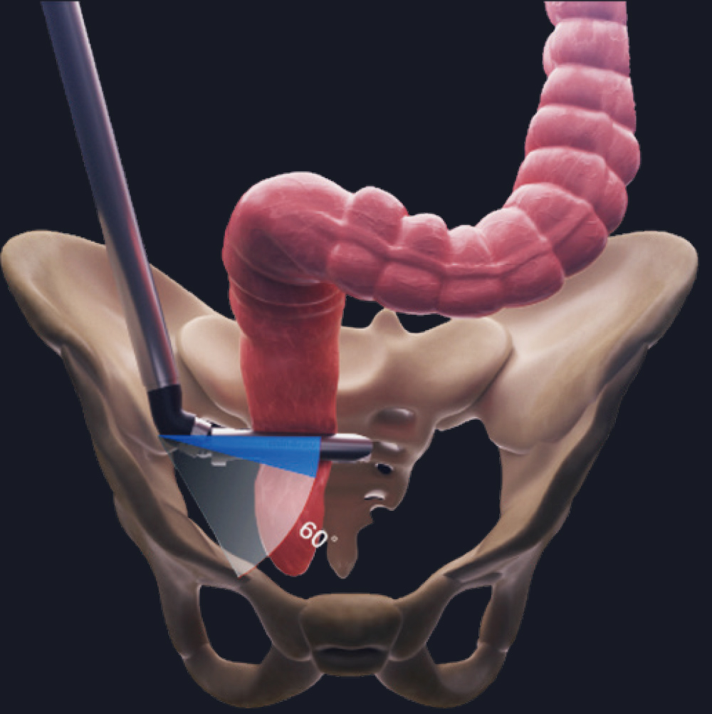 60° Articulating Angle movement in lower anterior rectum