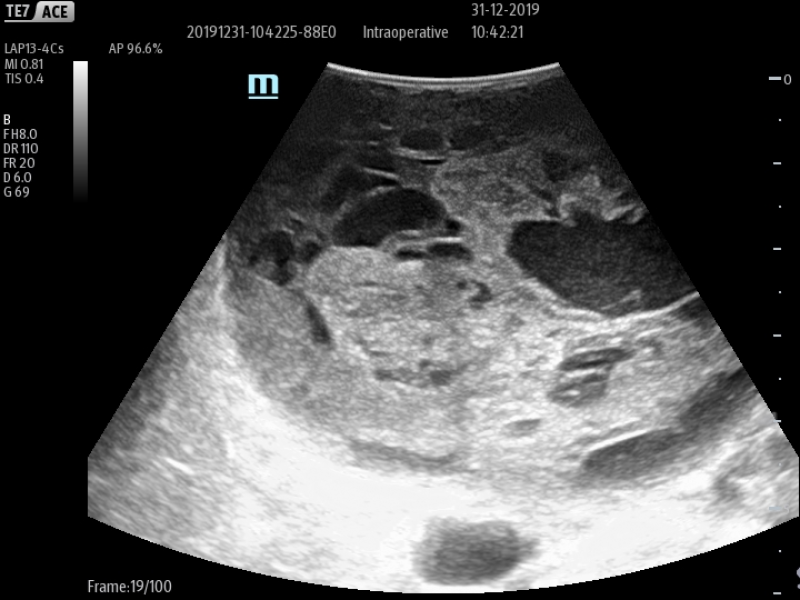 LAP13-4Cs_Liver_Tumor_1_800x600