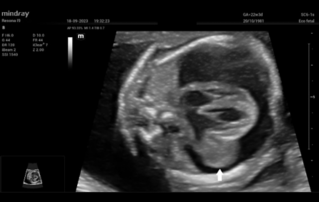 Ultrasound Journal 38 - Pericardio-Amniotic Shunting for Fetal Intrapericardial Teratoma
