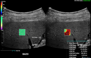 Ultrasound Journal 35 - Correlation between Splenic Stiffness by Elastography and Esophageal Varices in a Patient with Hepatic Cirrhosis: Presentation of a Clinical Case