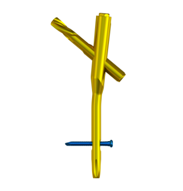 Clou Intramédullaire