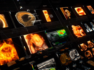 超声智能应用，，让更多女性享有高质高效的超声诊断